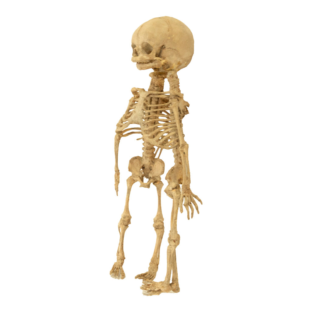 Antique 19th Century French Anatomical Conjoined Syncephalus Twins Skeleton Medical Model 1860