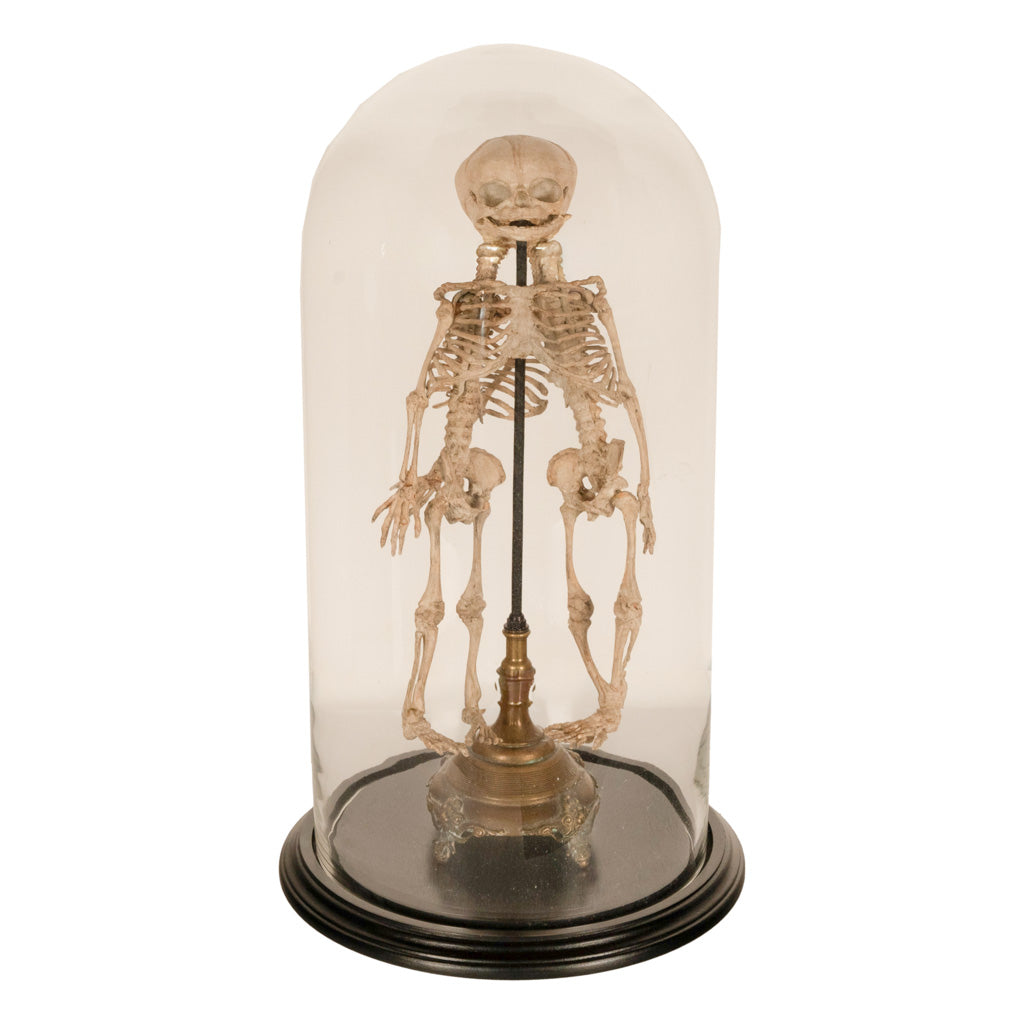Antique 19th Century French Anatomical Conjoined Syncephalus Twins Skeleton Medical Model 1860