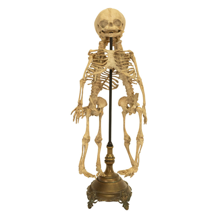 Antique 19th Century French Anatomical Conjoined Syncephalus Twins Skeleton Medical Model 1860