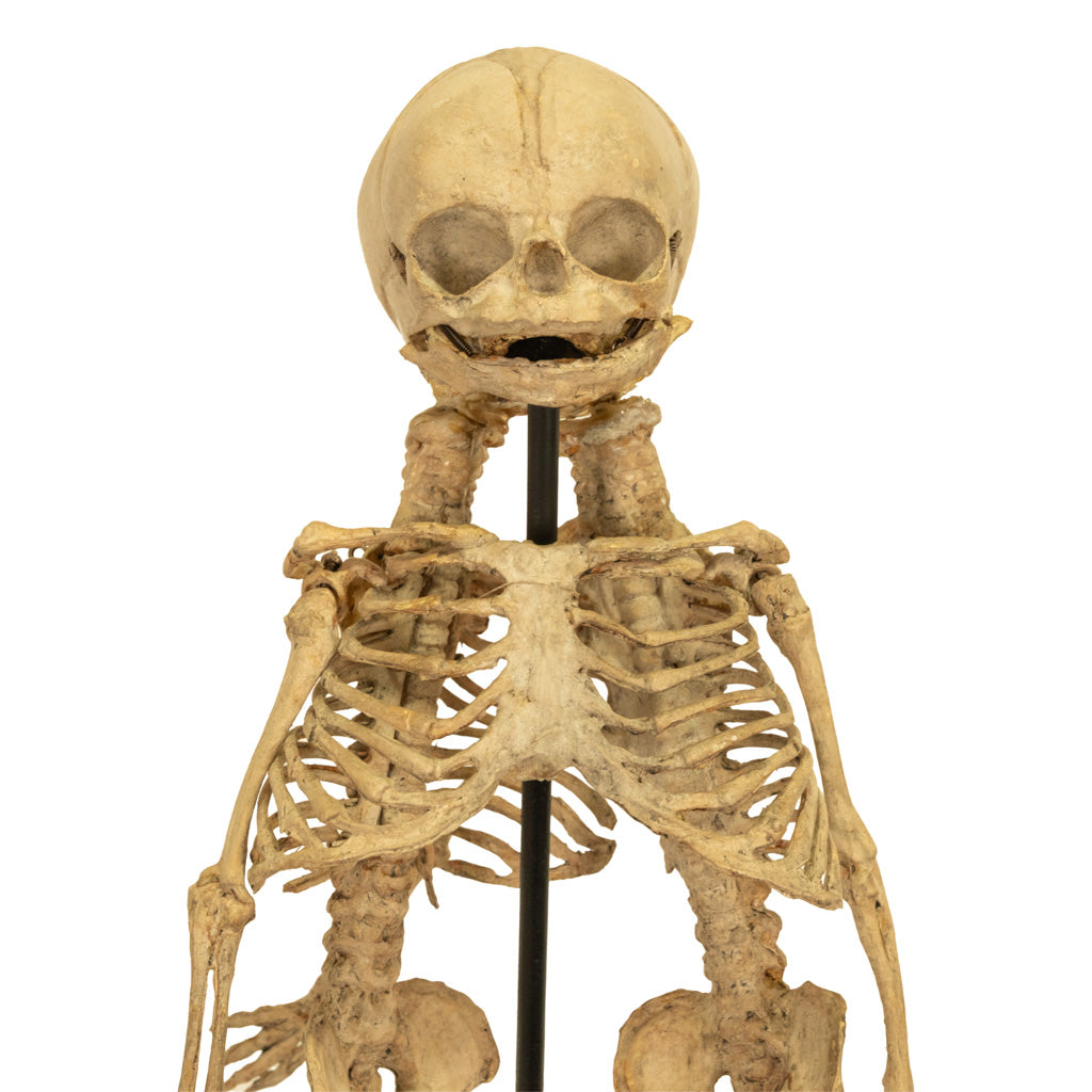 Antique 19th Century French Anatomical Conjoined Syncephalus Twins Skeleton Medical Model 1860