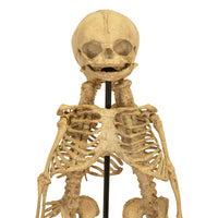 Antique 19th Century French Anatomical Conjoined Syncephalus Twins Skeleton Medical Model 1860