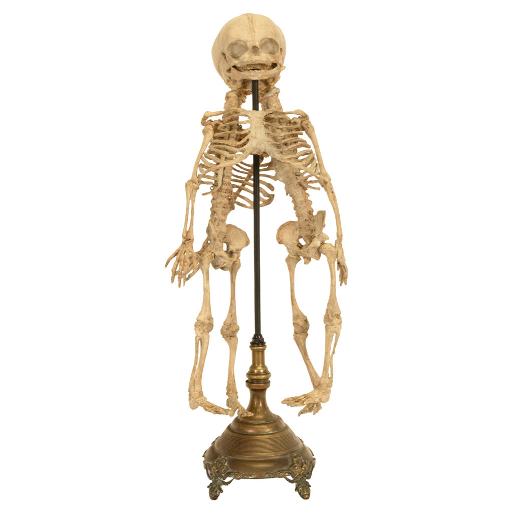 Antique 19th Century French Anatomical Conjoined Syncephalus Twins