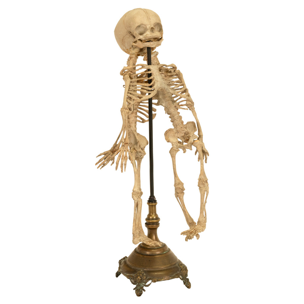 Antique 19th Century French Anatomical Conjoined Syncephalus Twins Skeleton Medical Model 1860
