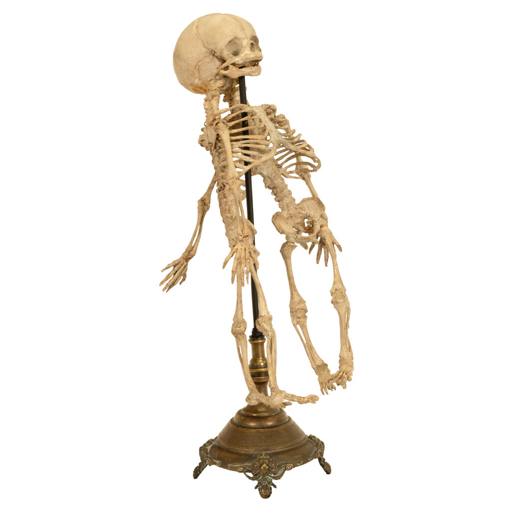 Antique 19th Century French Anatomical Conjoined Syncephalus Twins Skeleton Medical Model 1860