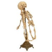 Antique 19th Century French Anatomical Conjoined Syncephalus Twins Skeleton Medical Model 1860
