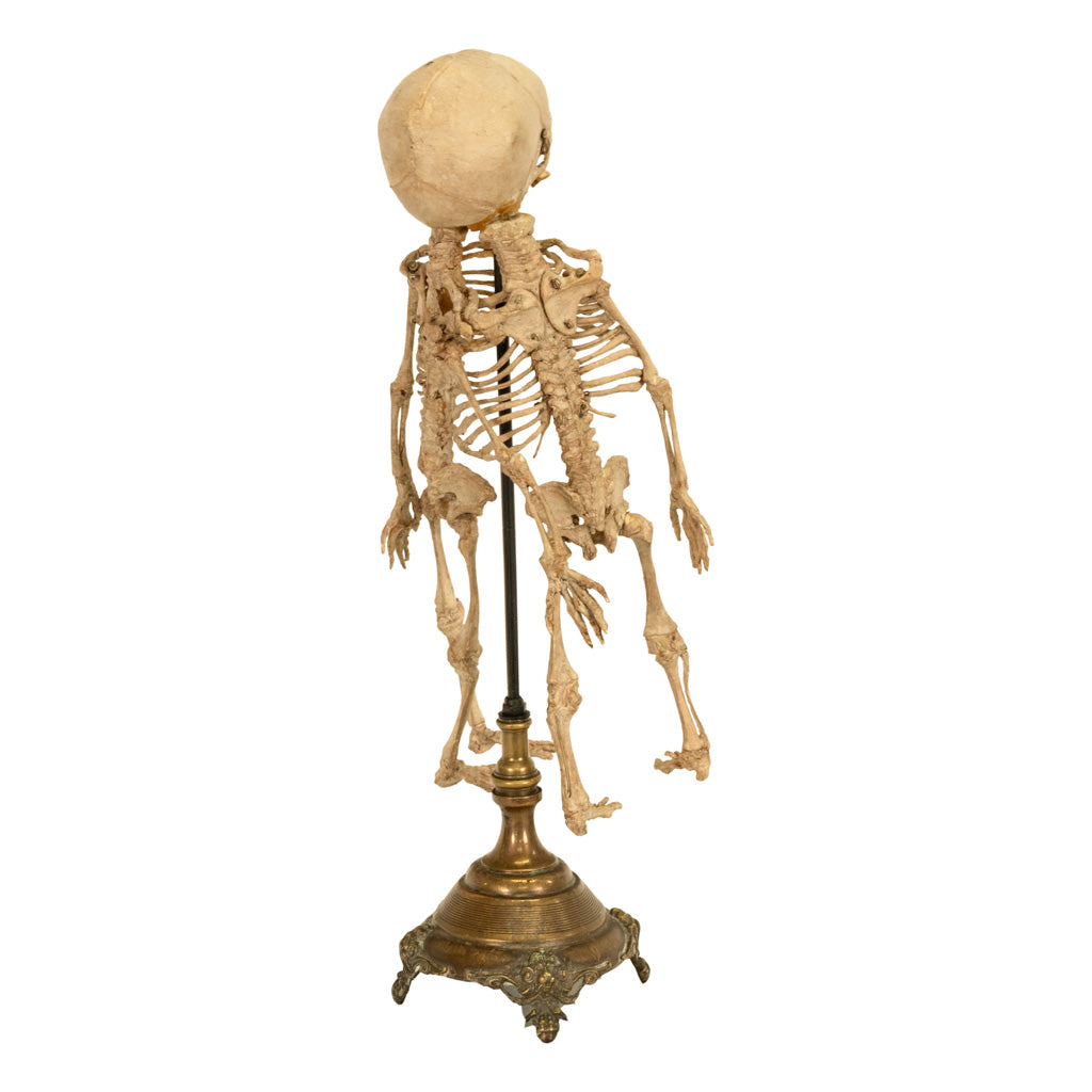 Antique 19th Century French Anatomical Conjoined Syncephalus Twins Skeleton Medical Model 1860